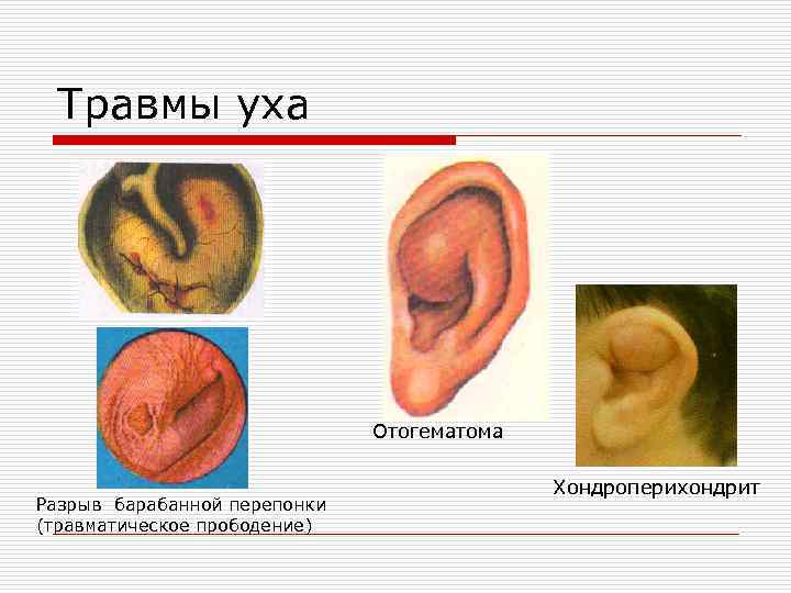 Травмы уха Отогематома Разрыв барабанной перепонки (травматическое прободение) Хондроперихондрит 