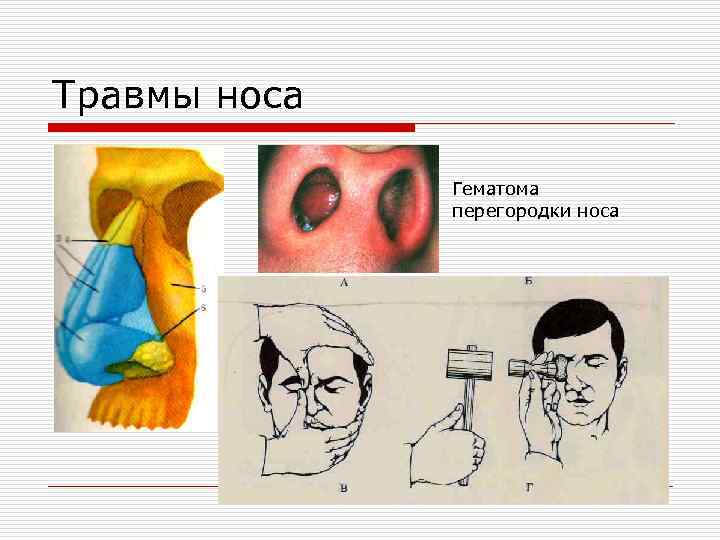 Травмы носа Гематома перегородки носа 