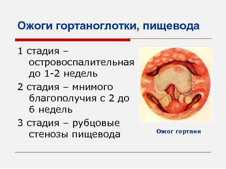 Ожоги гортаноглотки, пищевода 1 стадия – островоспалительная до 1 -2 недель 2 стадия –