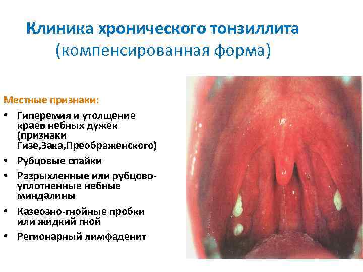 Клиника хронического тонзиллита (компенсированная форма) Местные признаки: • Гиперемия и утолщение краев небных дужек