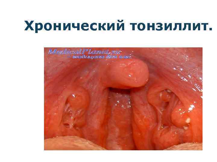 Хронический тонзиллит. 