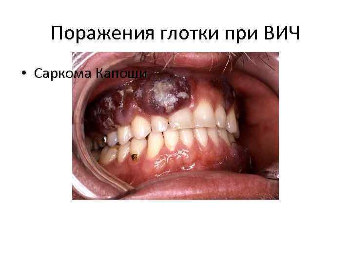 Поражения глотки при ВИЧ • Саркома Капоши 