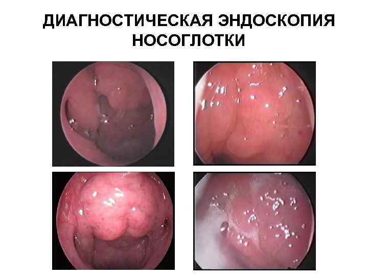 ДИАГНОСТИЧЕСКАЯ ЭНДОСКОПИЯ НОСОГЛОТКИ 