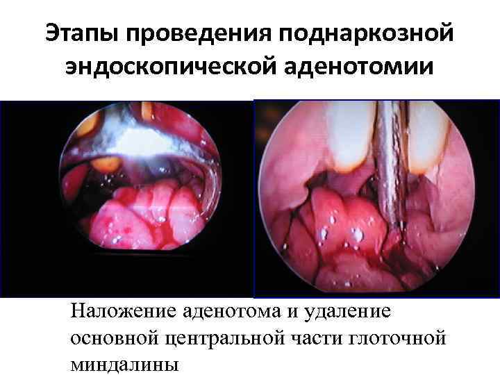 Этапы проведения поднаркозной эндоскопической аденотомии Наложение аденотома и удаление основной центральной части глоточной миндалины