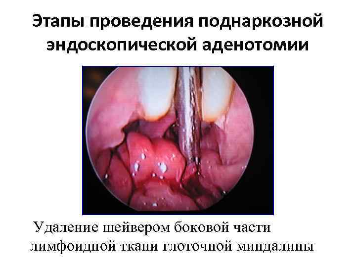 Этапы проведения поднаркозной эндоскопической аденотомии Удаление шейвером боковой части лимфоидной ткани глоточной миндалины 