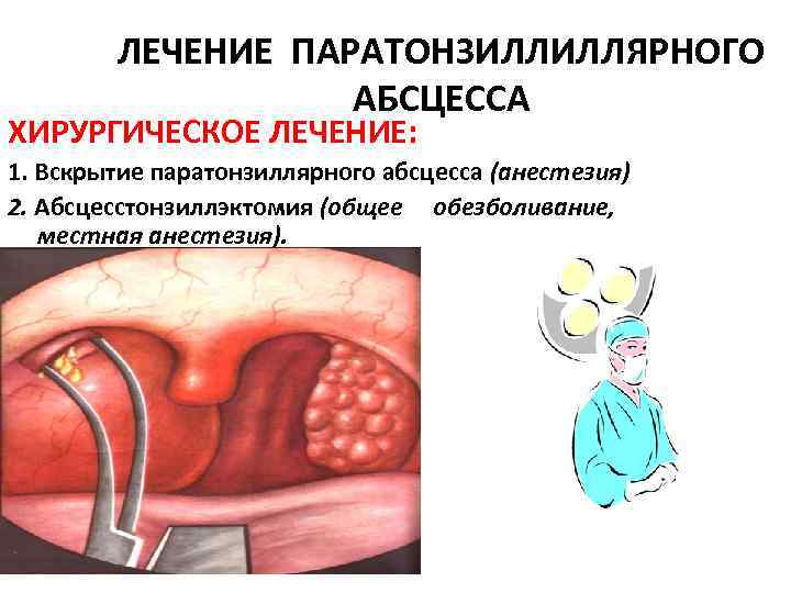 ЛЕЧЕНИЕ ПАРАТОНЗИЛЛИЛЛЯРНОГО АБСЦЕССА ХИРУРГИЧЕСКОЕ ЛЕЧЕНИЕ: 1. Вскрытие паратонзиллярного абсцесса (анестезия) 2. Абсцесстонзиллэктомия (общее обезболивание,