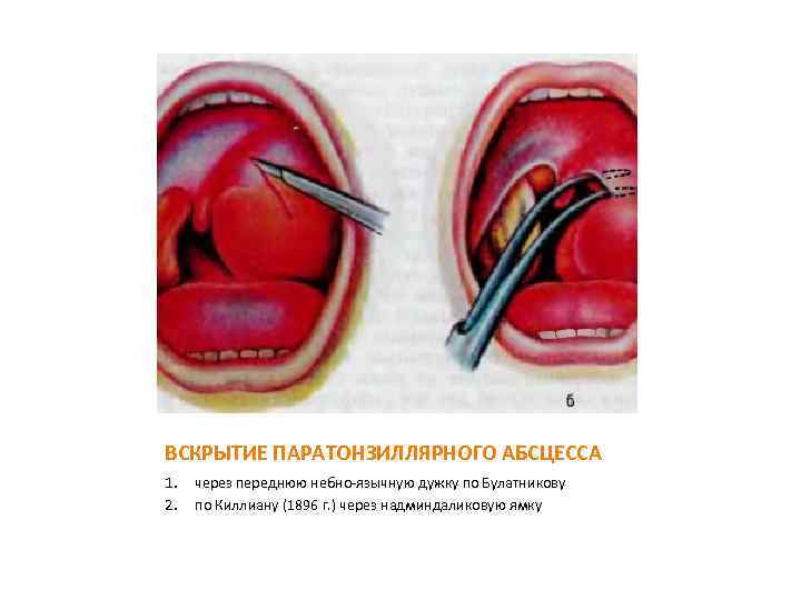 ВСКРЫТИЕ ПАРАТОНЗИЛЛЯРНОГО АБСЦЕССА 1. 2. через переднюю небно-язычную дужку по Булатникову по Киллиану (1896