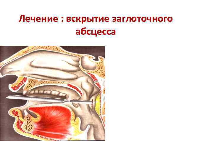 Лечение : вскрытие заглоточного абсцесса 