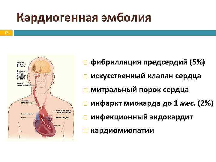 Кардиогенная эмболия 17 фибрилляция предсердий (5%) искусственный клапан сердца митральный порок сердца инфаркт миокарда
