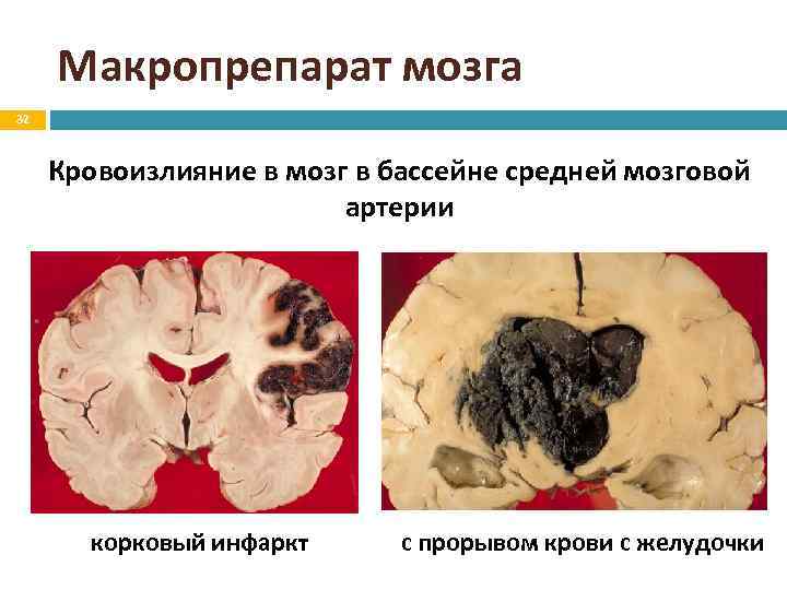 Макропрепарат мозга 32 Кровоизлияние в мозг в бассейне средней мозговой артерии корковый инфаркт с