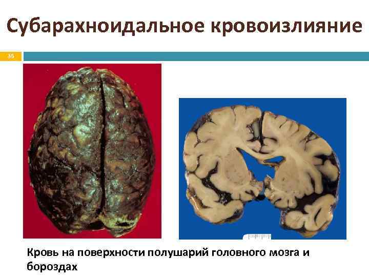 Субарахноидальное кровоизлияние 36 Кровь на поверхности полушарий головного мозга и бороздах 