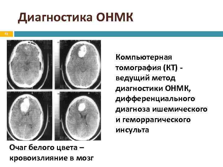 Диагностика ОНМК 41 Компьютерная томография (КТ) - ведущий метод диагностики ОНМК, дифференциального диагноза ишемического