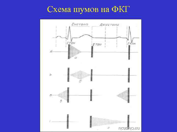 Схема шумов на ФКГ 