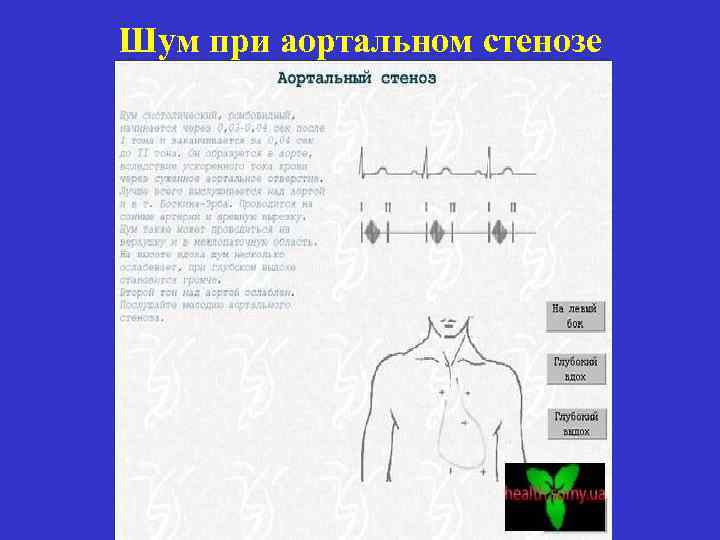 Шум при аортальном стенозе 