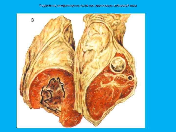 Поражение лимфатических узлов при хронизации сибирской язвы 