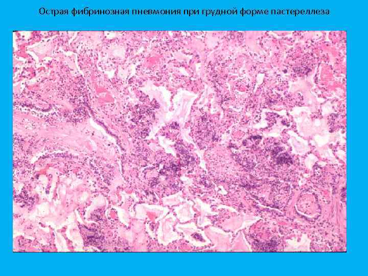 Острая фибринозная пневмония при грудной форме пастереллеза 