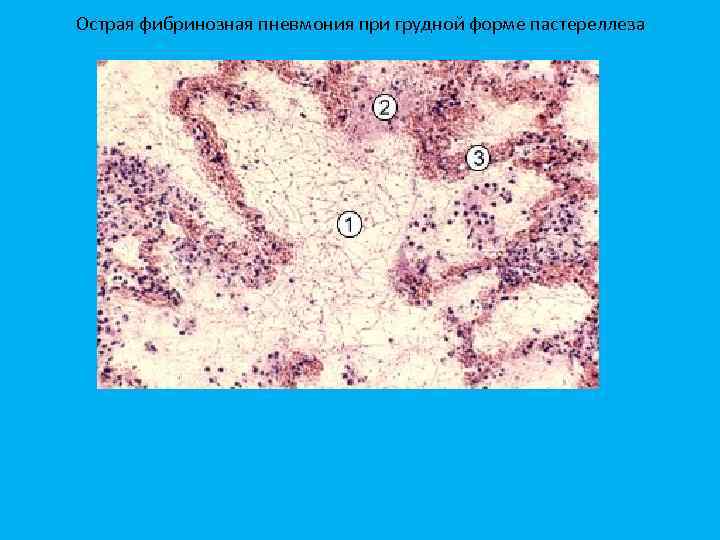 Острая фибринозная пневмония при грудной форме пастереллеза 