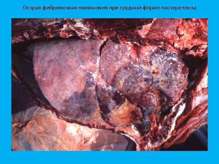 Острая фибринозная пневмония при грудной форме пастереллеза 