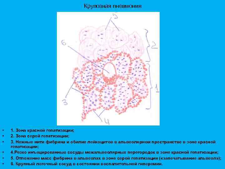 Крупозная пневмония • • • 1. Зона красной гепатизации; 2. Зона серой гепатизации; 3.