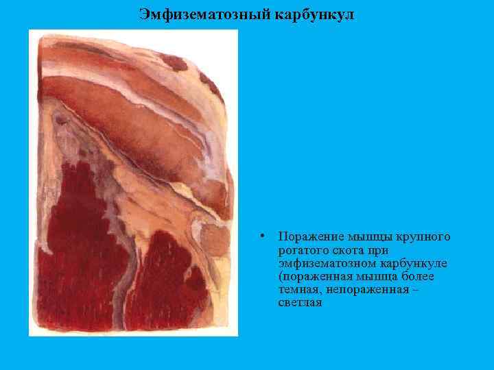 Эмфизематозный карбункул • Поражение мышцы крупного рогатого скота при эмфизематозном карбункуле (пораженная мышца более