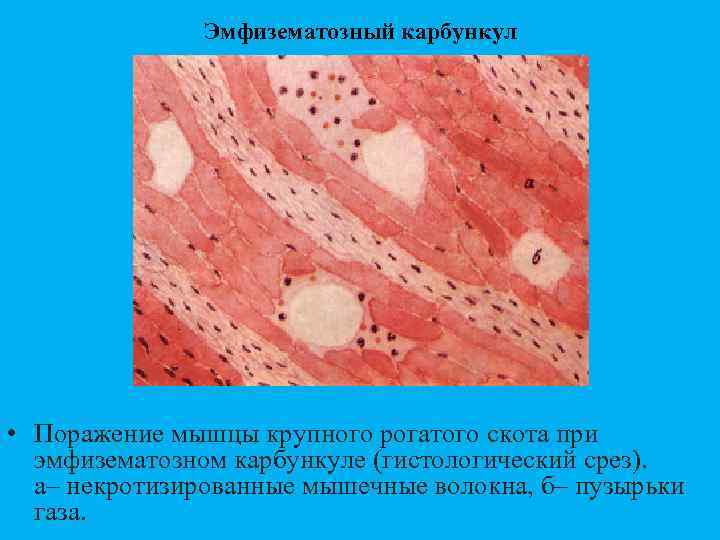 Эмфизематозный карбункул • Поражение мышцы крупного рогатого скота при эмфизематозном карбункуле (гистологический срез). а–