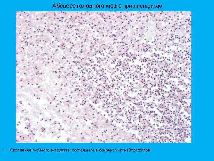 Абсцесс головного мозга при листериозе • Скопление гнойного экссудата, состоящего в основном из нейтрофилов