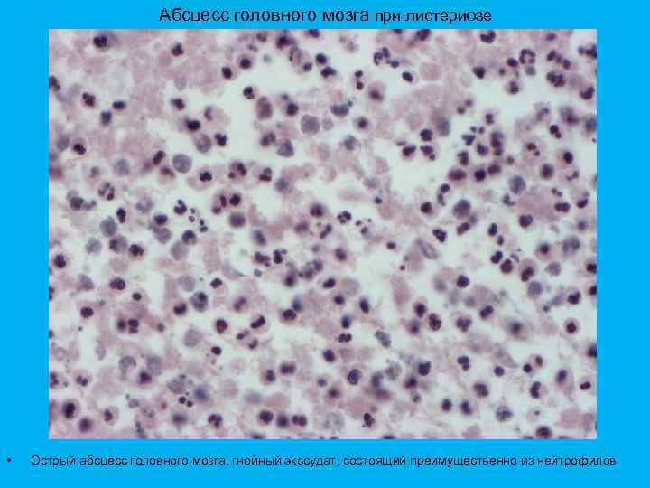 Абсцесс головного мозга при листериозе • Острый абсцесс головного мозга, гнойный экссудат, состоящий преимущественно