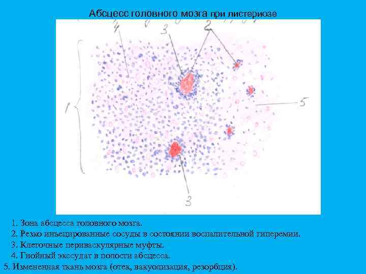 Абсцесс головного мозга при листериозе 1. Зона абсцесса головного мозга. 2. Резко инъецированные сосуды