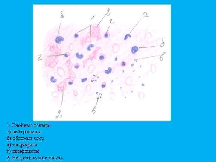 1. Гнойные тельца: а) нейтрофилы б) обломки ядер в) макрофаги г) лимфоциты 2. Некротические