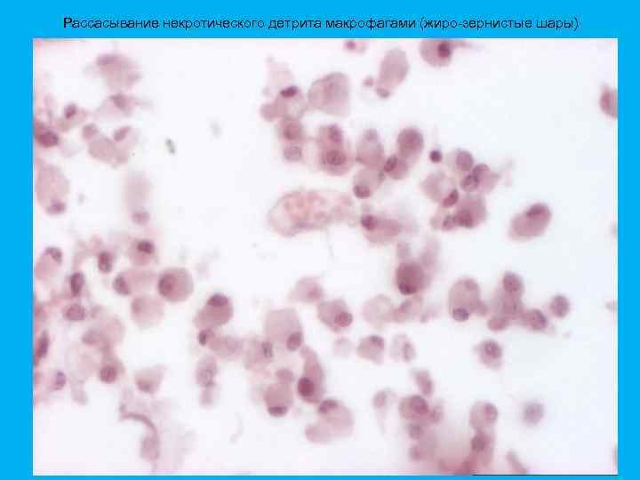 Рассасывание некротического детрита макрофагами (жиро-зернистые шары) 