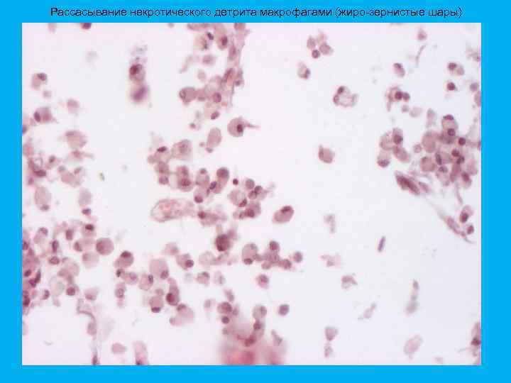 Рассасывание некротического детрита макрофагами (жиро-зернистые шары) 