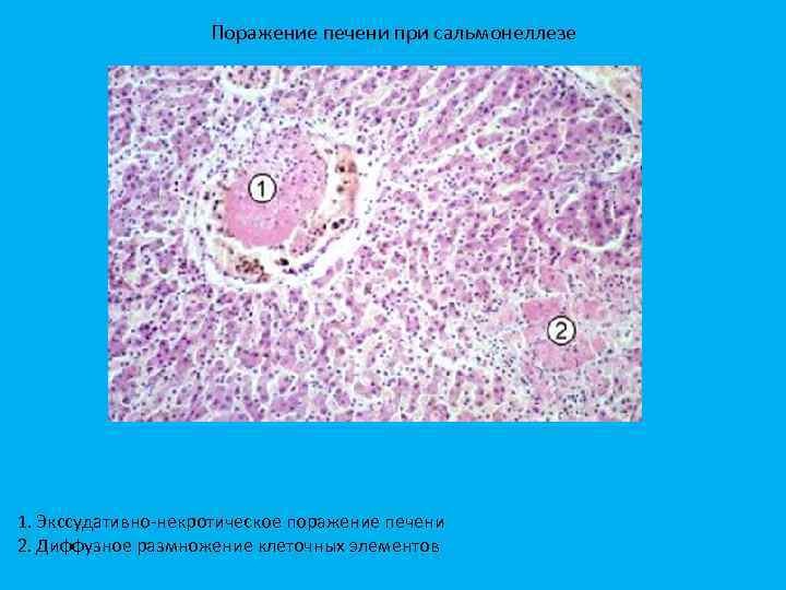 Поражение печени при сальмонеллезе 1. Экссудативно некротическое поражение печени 2. Диффузное размножение клеточных элементов