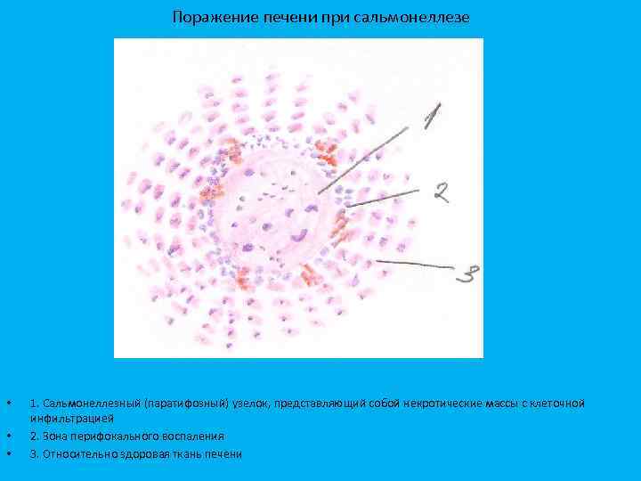 Поражение печени при сальмонеллезе • • • 1. Сальмонеллезный (паратифозный) узелок, представляющий собой некротические