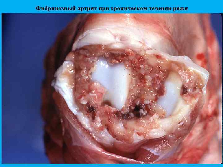 Фибринозный артрит при хроническом течении рожи 