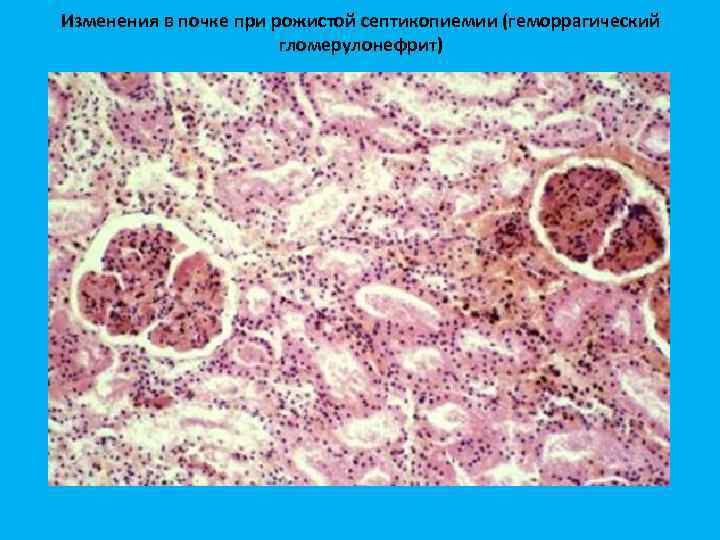 Изменения в почке при рожистой септикопиемии (геморрагический гломерулонефрит) 