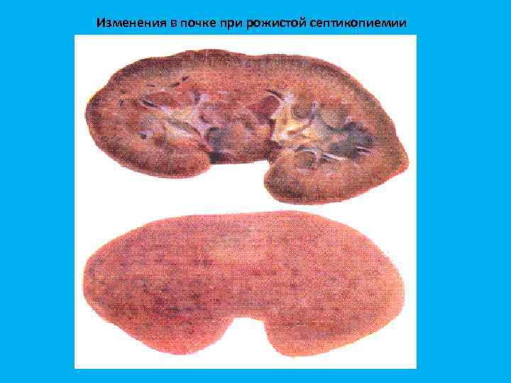 Изменения в почке при рожистой септикопиемии 