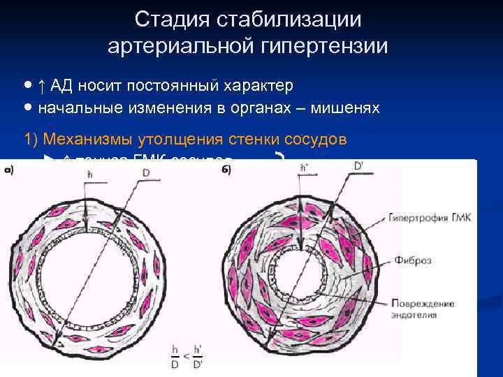 Стадия стабилизации артериальной гипертензии ● ↑ АД носит постоянный характер ● начальные изменения в