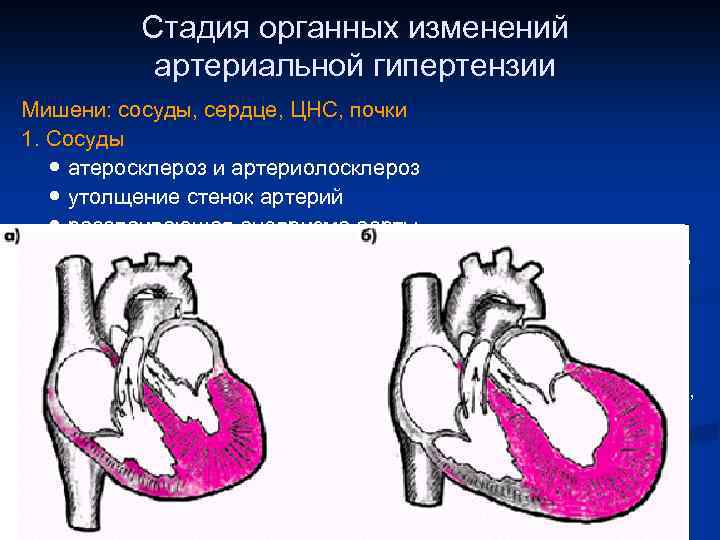 Стадия органных изменений артериальной гипертензии Мишени: сосуды, сердце, ЦНС, почки 1. Сосуды ● атеросклероз