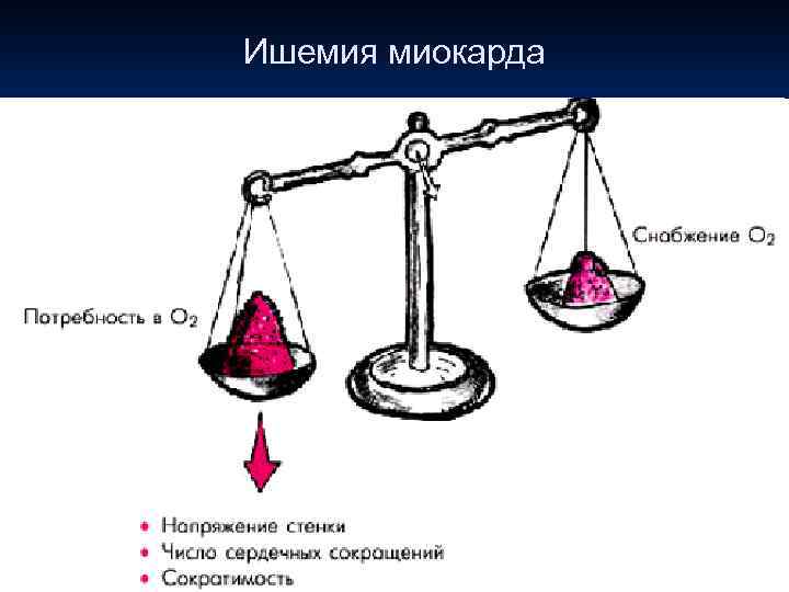 Ишемия миокарда ● обусловлена острым или хроническим несоответствием потребности миокарда в кислороде и реального