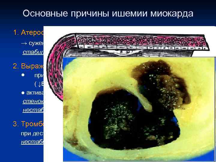 Основные причины ишемии миокарда 1. Атеросклероз (95 – 97 %) – ПКА, ЛКА (ОВ,