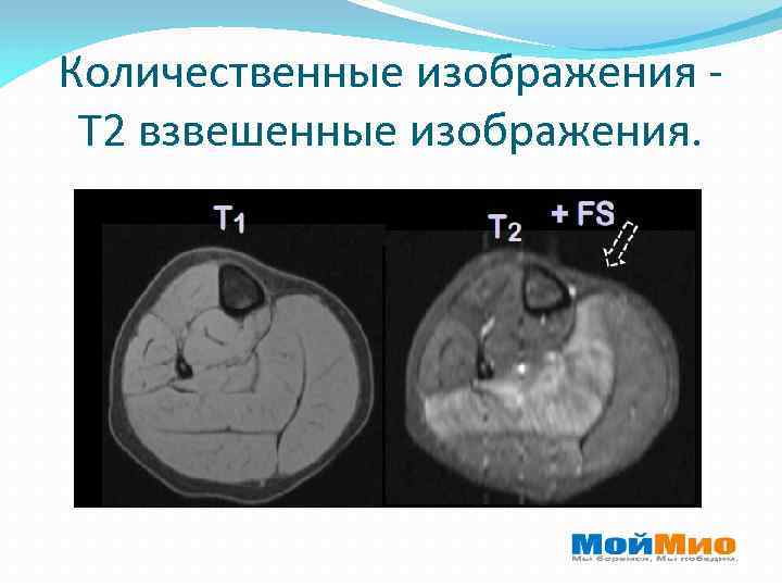 Т1 и т2 изображения мрт