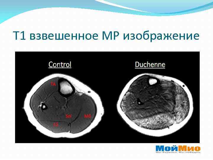 Т 1 взвешенное МР изображение 