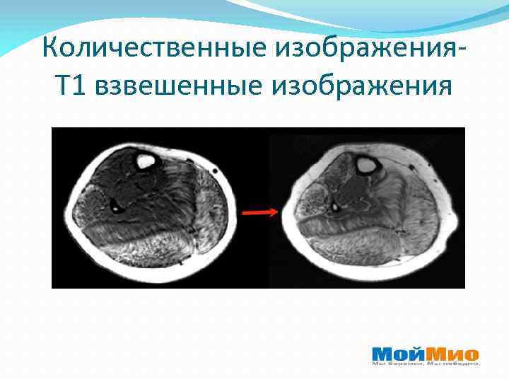 Количественные изображения. T 1 взвешенные изображения 