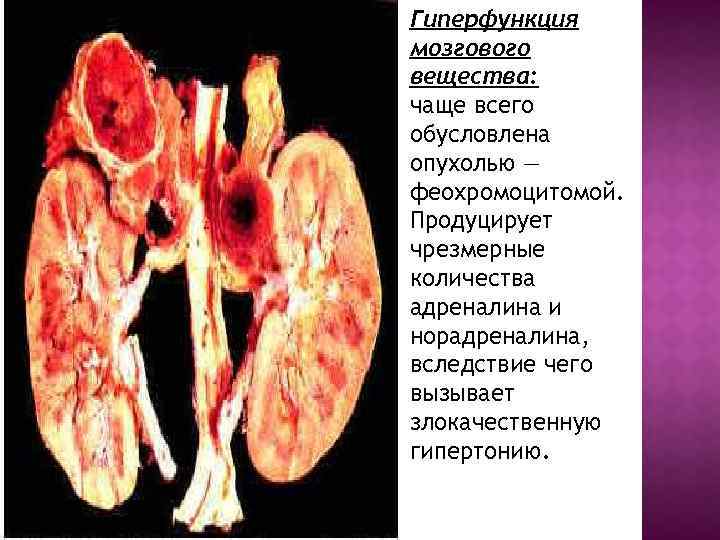 Гиперфункция мозгового вещества: чаще всего обусловлена опухолью — феохромоцитомой. Продуцирует чрезмерные количества адреналина и