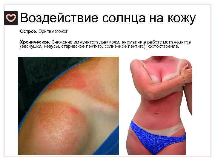 Воздействие солнца на кожу Острое. Эритема/ожог Хроническое. Снижение иммунитета, рак кожи, аномалии в работе