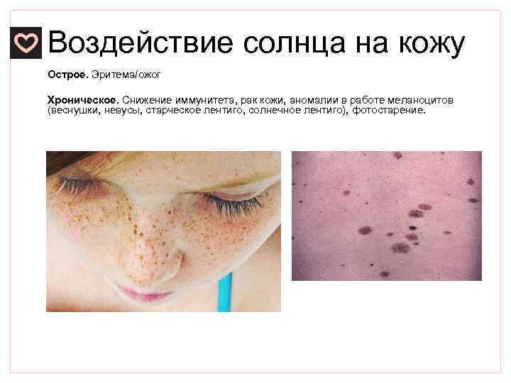 Воздействие солнца на кожу Острое. Эритема/ожог Хроническое. Снижение иммунитета, рак кожи, аномалии в работе