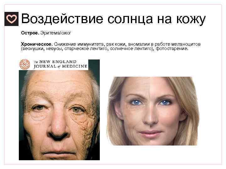 Воздействие солнца на кожу Острое. Эритема/ожог Хроническое. Снижение иммунитета, рак кожи, аномалии в работе