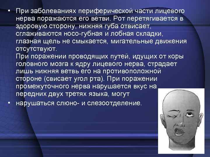  • При заболеваниях периферической части лицевого нерва поражаются его ветви. Рот перетягивается в