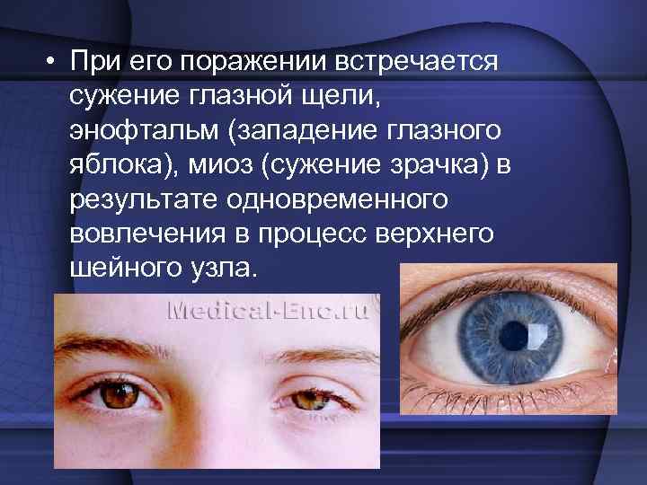  • При его поражении встречается сужение глазной щели, энофтальм (западение глазного яблока), миоз