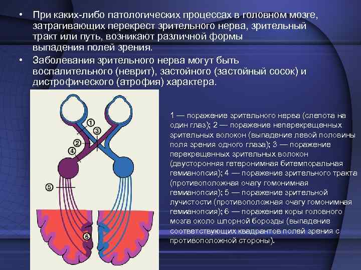  • При каких либо патологических процессах в головном мозге, затрагивающих перекрест зрительного нерва,